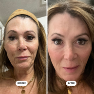 Million Dollar Micro-Infusion Kit