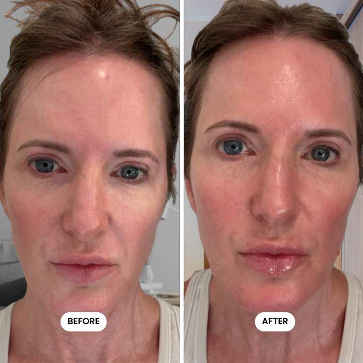Million Dollar Micro-Infusion Kit