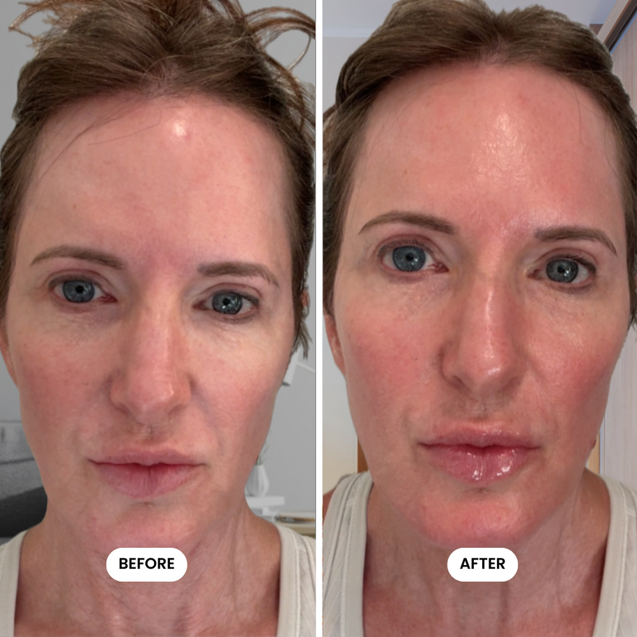 Million Dollar Micro-Infusion Kit