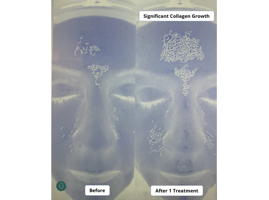 Beautify Micro-Infusion Kit