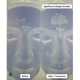 Beautify Micro-Infusion Kit