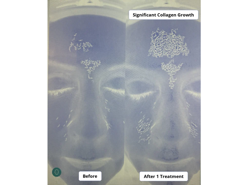 Beautify Micro-Infusion Kit